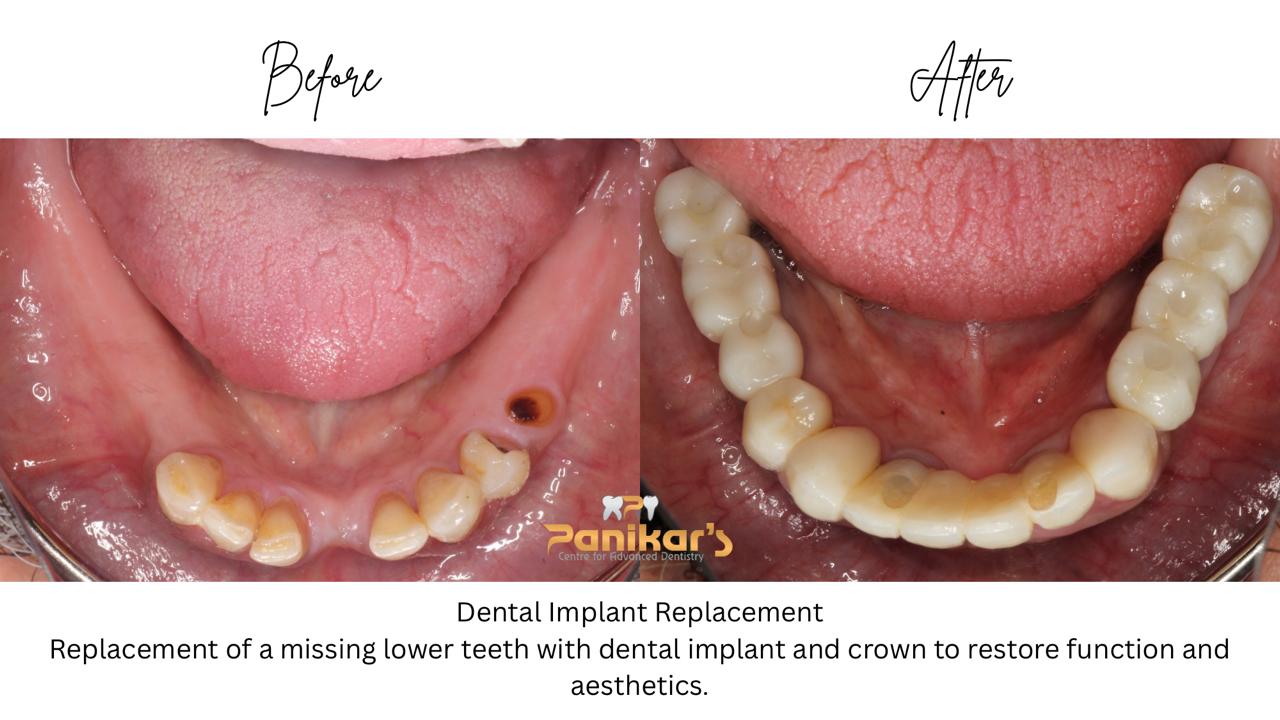 Implant Case